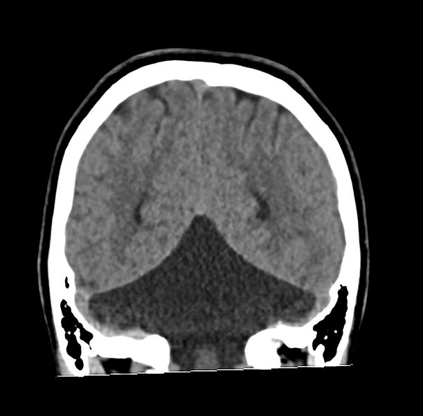 File:Cerebellar agenesis (Radiopaedia 30203-30817 Coronal non-contrast 35).jpg