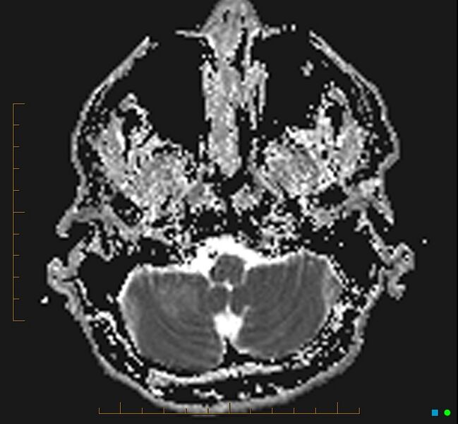 File:Cerebellar gangliocytoma (Radiopaedia 65377-74422 Axial ADC 5).jpg