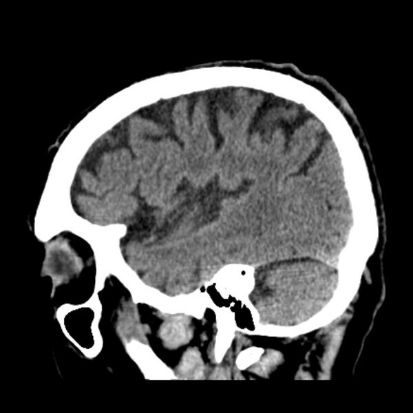 File:Cerebellar hemorrhage (Radiopaedia 27193-27359 C 11).jpg