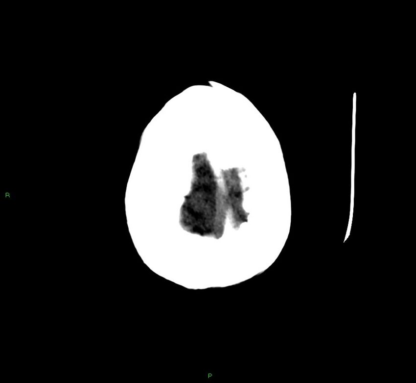 Cerebellar hemorrhage (Radiopaedia 58792-66026 Axial non-contrast 5).jpg
