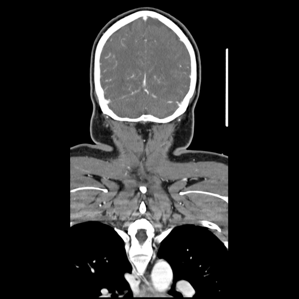 File:Cerebellar infarct due to vertebral artery dissection with posterior fossa decompression (Radiopaedia 82779-97029 D 51).png
