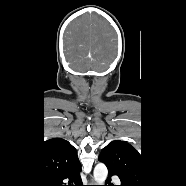 File:Cerebellar infarct due to vertebral artery dissection with posterior fossa decompression (Radiopaedia 82779-97029 D 52).png