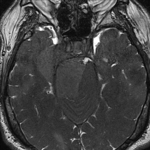 File:Cerebellopontine angle meningioma (Radiopaedia 24459-24764 I 32).jpg