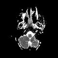 Cerebral abscess post cardiac surgery (Radiopaedia 27244-27420 Axial ADC 3).jpg