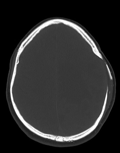 File:Cerebral abscesses (Radiopaedia 70458-80568 Axial bone window 43).jpg