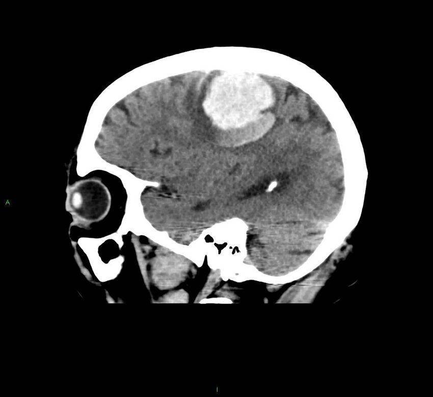 Cerebral amyloid angiopathy-associated lobar intracerebral hemorrhage (Radiopaedia 58376-65511 C 39).jpg