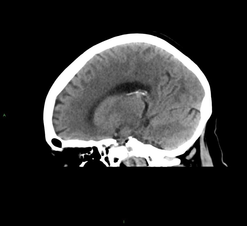 Cerebral amyloid angiopathy-associated lobar intracerebral hemorrhage (Radiopaedia 58378-65516 C 31).jpg