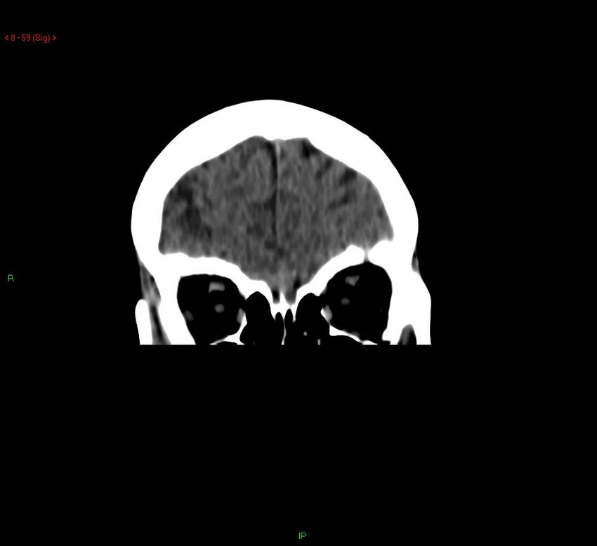 Cerebral amyloid angiopathy-associated lobar intracerebral hemorrhage (Radiopaedia 58378-65518 Coronal non-contrast 59).jpg