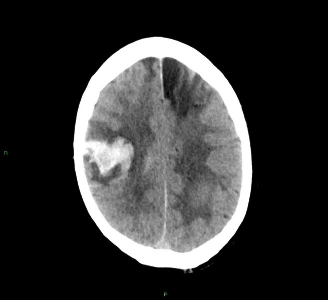 File:Cerebral amyloid angiopathy-associated lobar intracerebral hemorrhage (Radiopaedia 58529-65687 Axial non-contrast 17).jpg