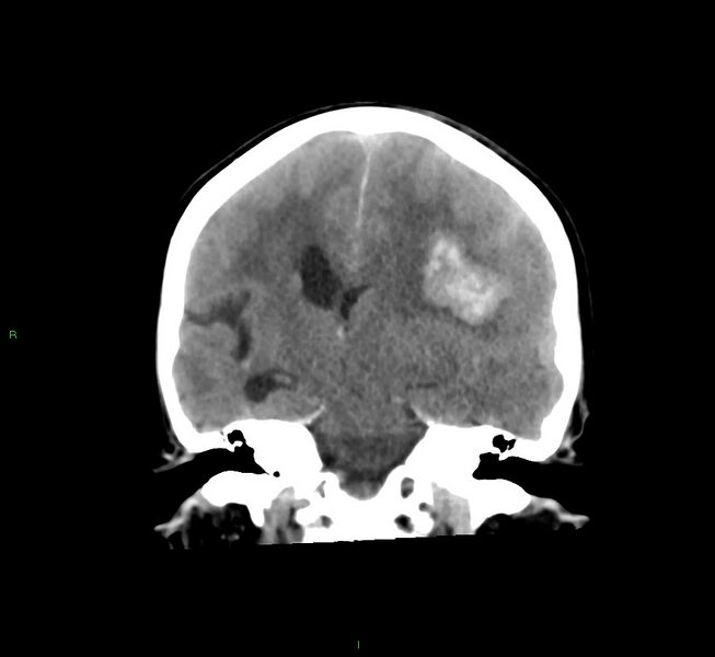 File:Cerebral amyloid angiopathy-associated lobar intracerebral hemorrhage (Radiopaedia 58561-65724 Coronal non-contrast 31).jpg