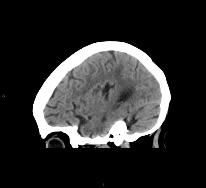 File:Cerebral amyloid angiopathy-associated lobar intracerebral hemorrhage (Radiopaedia 58563-65727 C 39).jpg