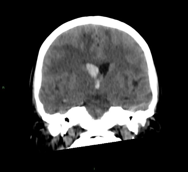 File:Cerebral amyloid angiopathy-associated lobar intracerebral hemorrhage (Radiopaedia 58566-65730 Coronal non-contrast 39).jpg