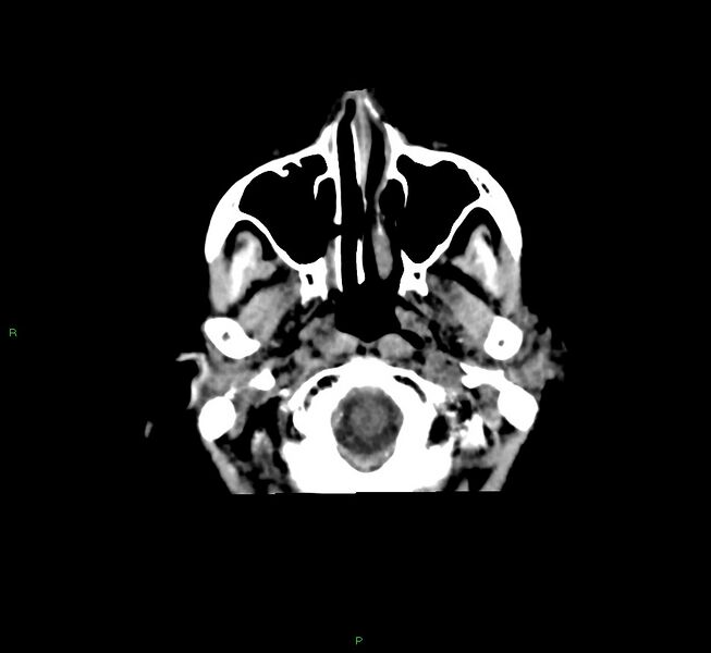 File:Cerebral amyloid angiopathy-associated lobar intracerebral hemorrhage (Radiopaedia 58751-65972 Axial non-contrast 46).jpg