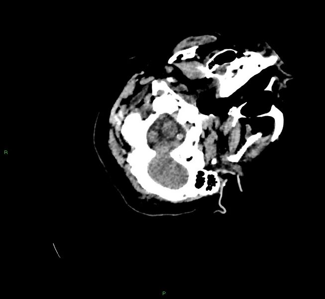 File:Cerebral amyloid angiopathy-associated lobar intracerebral hemorrhage (Radiopaedia 58757-65979 Axial non-contrast 17).jpg