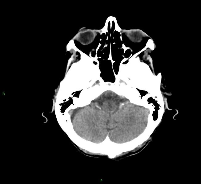 File:Cerebral amyloid angiopathy-associated lobar intracerebral hemorrhage (Radiopaedia 58758-65980 Axial non-contrast 40).jpg