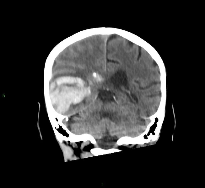 File:Cerebral amyloid angiopathy-associated lobar intracerebral hemorrhage (Radiopaedia 58758-65980 Coronal non-contrast 25).jpg