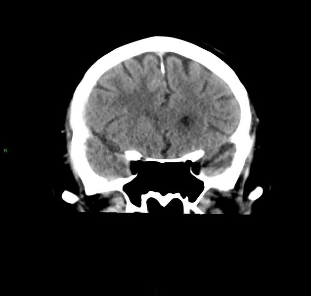 File:Cerebral amyloid angiopathy-associated lobar intracerebral hemorrhage (Radiopaedia 59356-66716 Coronal non-contrast 45).jpg