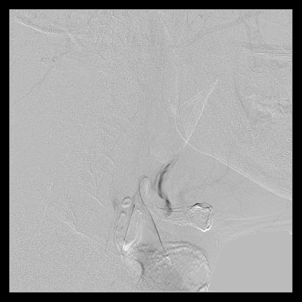 File:Cerebral arteriovenous malformation (Spetzler-Martin grade 2) (Radiopaedia 41262-44097 B 15).png