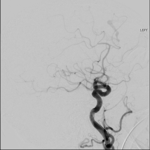 File:Cerebral arteriovenous malformation with lobar hemorrhage (Radiopaedia 44725-48513 LT CCA IC 34).png