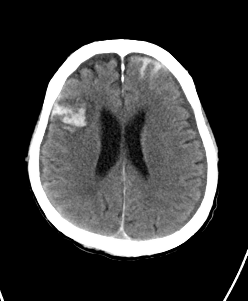 File:Cerebral contusions, subarachnoid hemorrhage and subdural hygromas (Radiopaedia 55399-61828 Axial non-contrast 18).png