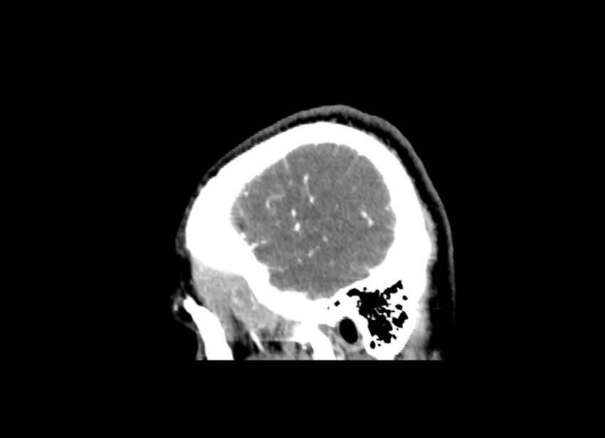 Cerebral edema (Radiopaedia 82519-96661 D 9).jpg