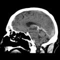 Cerebral hemorrhagic contusions (Radiopaedia 23145-23188 C 21).jpg