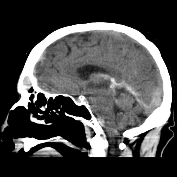 File:Cerebral hemorrhagic contusions (Radiopaedia 23145-23188 C 21).jpg