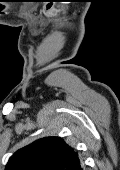 File:Cerebral hemorrhagic contusions and cervical spine fractures (Radiopaedia 32865-33841 G 107).jpg