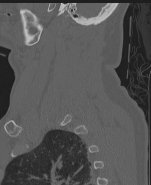 File:Cerebral hemorrhagic contusions and cervical spine fractures (Radiopaedia 32865-33841 Sagittal bone window 81).jpg