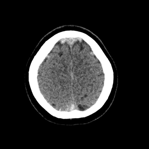 File:Cerebral venous sinus thrombosis (Radiopaedia 59224-66551 Axial non-contrast 44).jpg