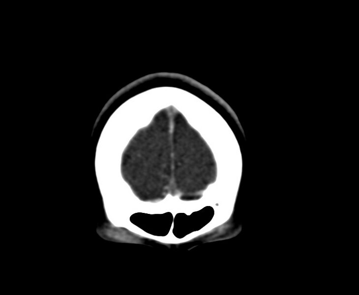 File:Cerebral venous sinus thrombosis (Radiopaedia 59224-66646 Coronal C+ delayed 2).jpg
