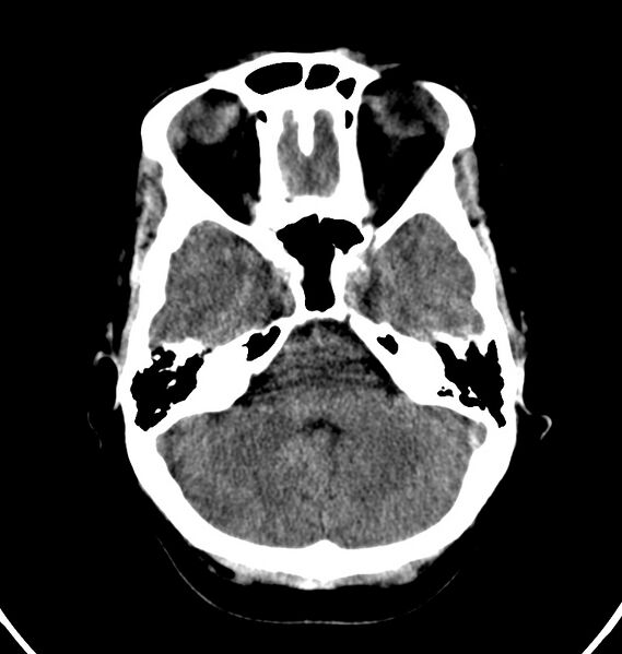 File:Cerebral venous thrombosis - CT only (Radiopaedia 41031-43778 Axial non-contrast 65).jpg