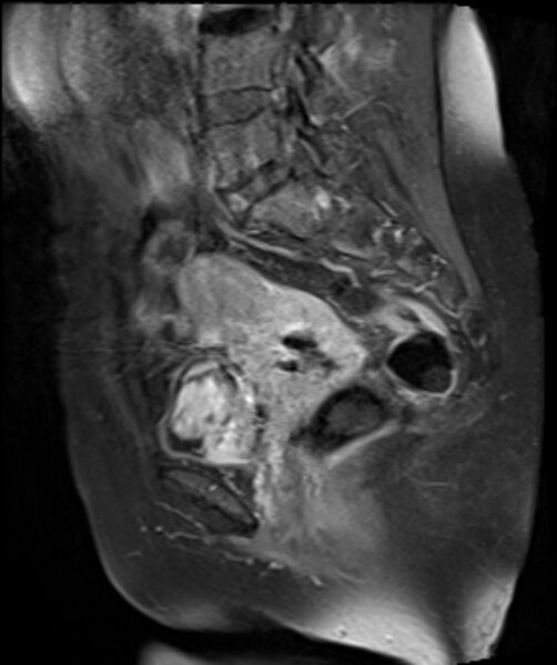 File:Cervical carcinoma (Radiopaedia 88312-104943 E 17).jpg