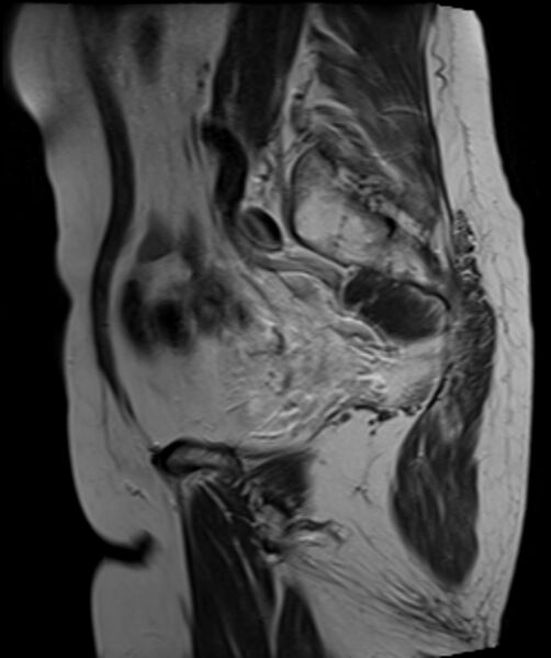 File:Cervical carcinoma (Radiopaedia 88312-104943 Sagittal T2 21).jpg