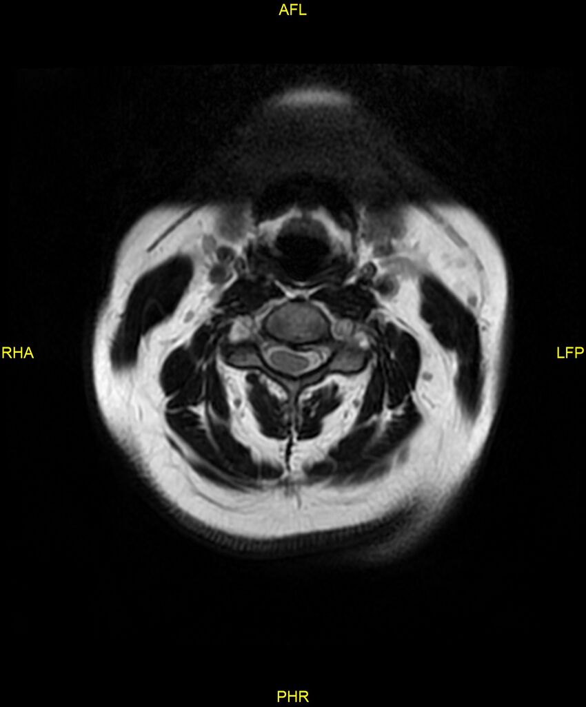 Cervical disc protrusion (Radiopaedia 87147-103415 Axial T2 3).jpg