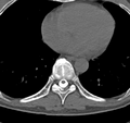 Cervical dural CSF leak on MRI and CT treated by blood patch (Radiopaedia 49748-54996 B 67).png