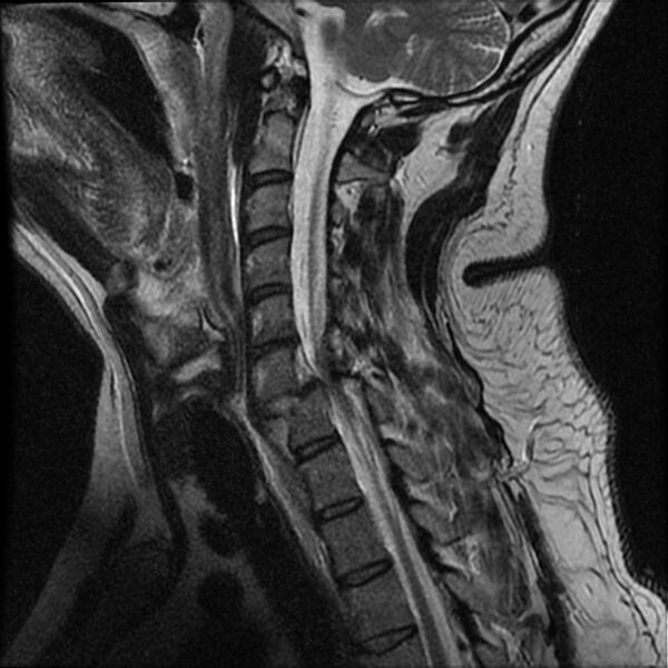 File:Cervical fracture and dislocation with locked facet (Radiopaedia 31837-32781 Sagittal T2 10).jpg