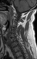Cervical schwannoma (Radiopaedia 72399-82934 Sagittal T1 8).jpg