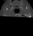 Cervical spine ACDF loosening (Radiopaedia 48998-54070 Axial bone window 2).png