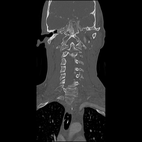 File:Cervical spine fractures with vertebral artery dissection (Radiopaedia 32135-33078 Coronal bone window 11).jpg