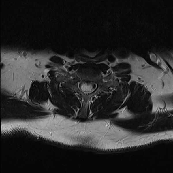 File:Cervical tumor-like myelopathy due to Type V dAVF (Radiopaedia 82461-96604 Axial T2 28).jpg