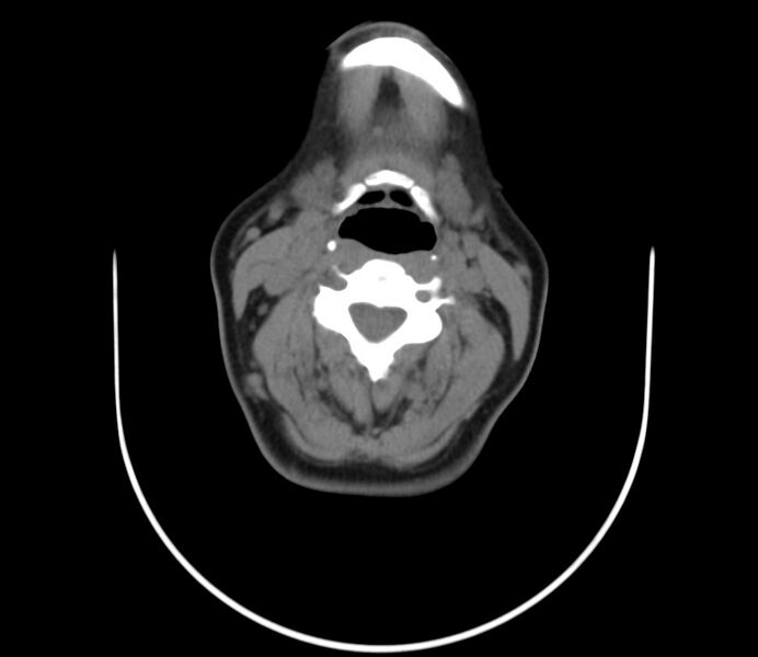 File:Cervical venous malformation (Radiopaedia 22653-22672 Axial non-contrast 31).jpg