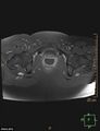 Cesarian scar endometriosis (Radiopaedia 68495-78066 Axial T1 C+ fat sat 22).jpg