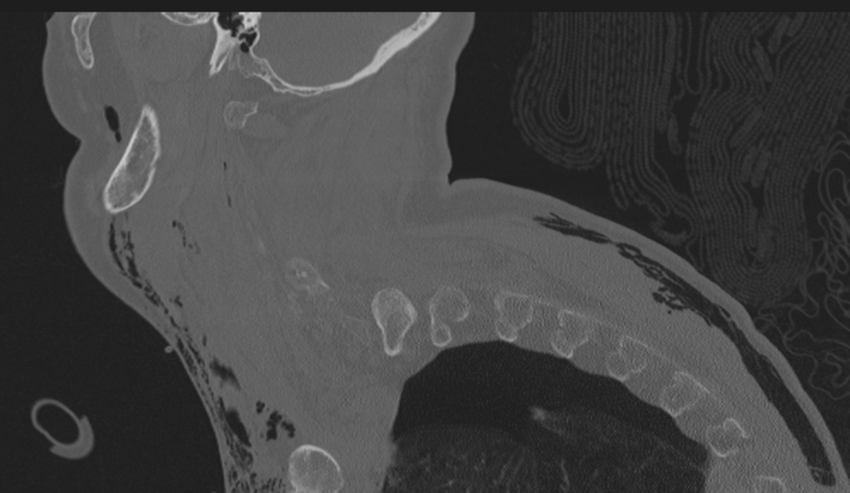 Chalk stick fracture (Radiopaedia 57948-64928 Sagittal bone window 9).png