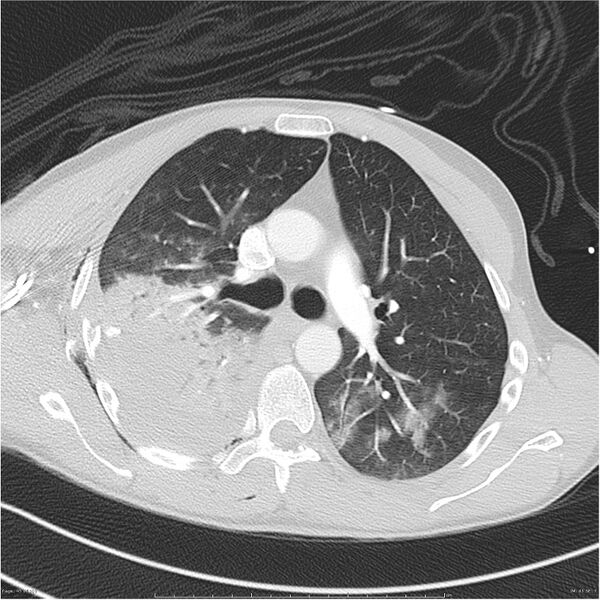 File:Chest and abdomen multi-trauma (Radiopaedia 26294-26425 lung window 45).jpg