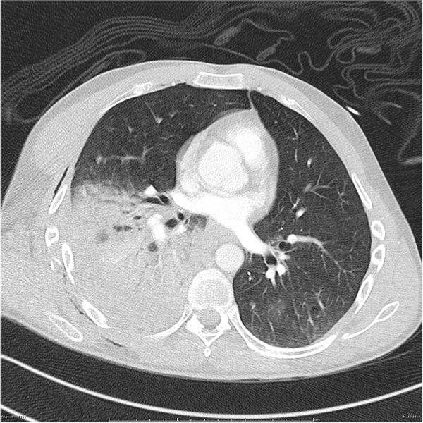 File:Chest and abdomen multi-trauma (Radiopaedia 26294-26425 lung window 59).jpg