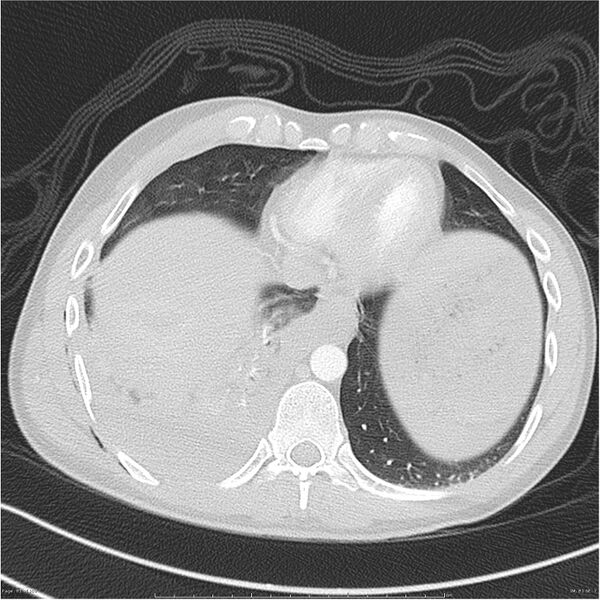File:Chest and abdomen multi-trauma (Radiopaedia 26294-26425 lung window 81).jpg