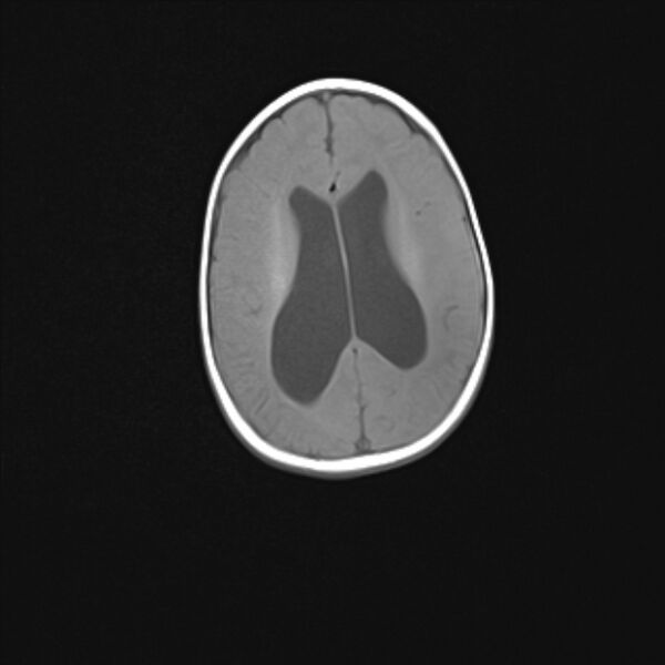 File:Chiari III malformation with occipital encephalocele (Radiopaedia 79446-92559 Axial T1 18).jpg