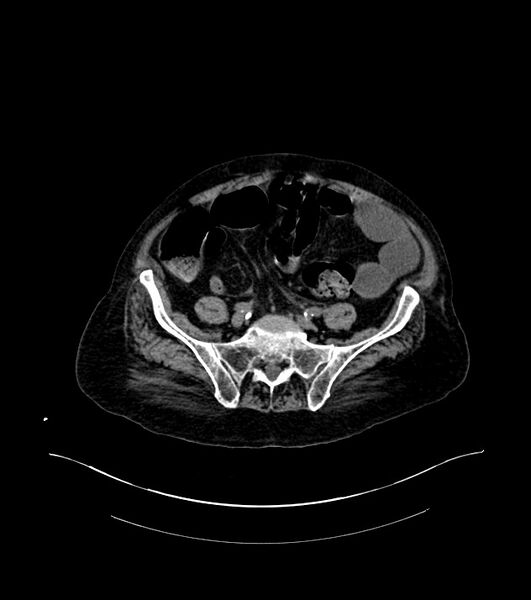 File:Cholangiocarcinoma with cerebral metastases (Radiopaedia 83519-98629 Axial non-contrast 91).jpg
