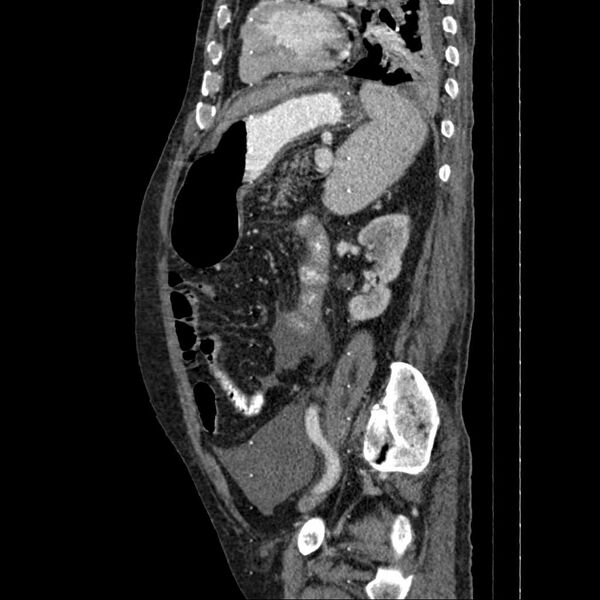 File:Cholangitis and abscess formation in a patient with cholangiocarcinoma (Radiopaedia 21194-21100 B 6).jpg